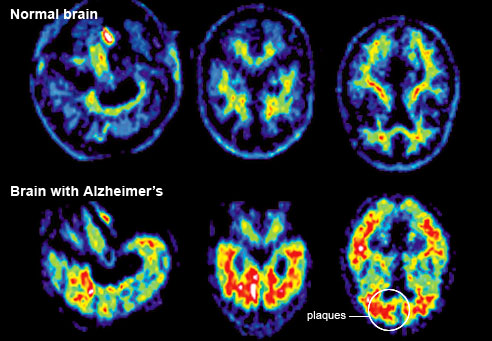 Un sistema fiable de detección de Alzheimer