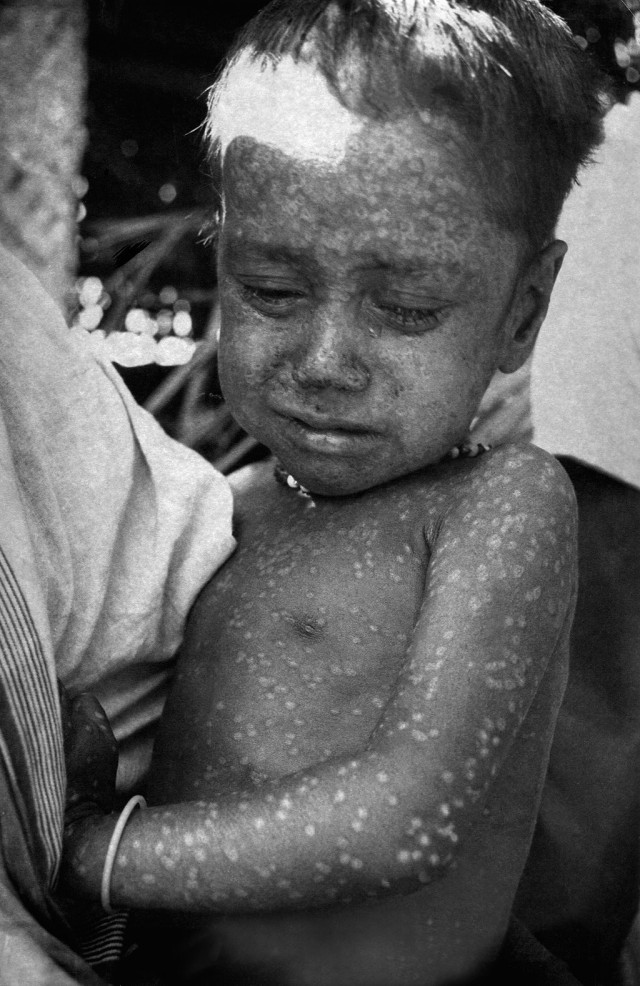 Lesiones de viruela. Última persona que sufrió la infección natural de este virus. Fuente: commons Wikipedia.org