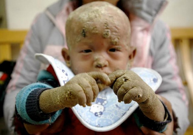 Son Sheng es un niño chino que nació con ictiosis lamelar y es conocido como "el niño pez". Fuente